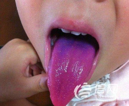 吃完蛋糕舌头变紫