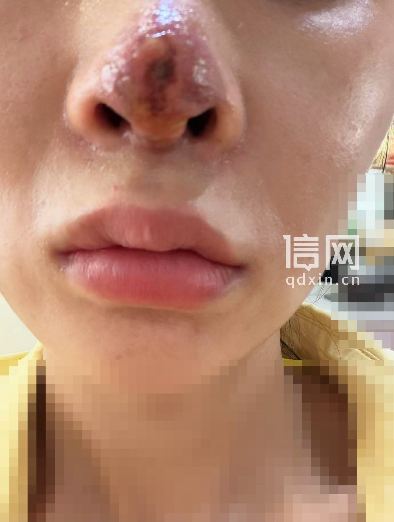 陶女士术后鼻子情况（来源： 受访者）