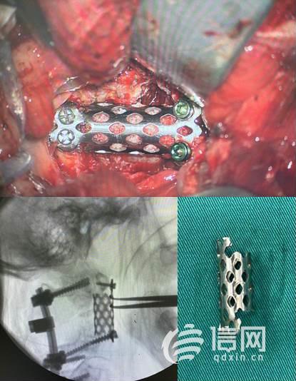 根据3d打印模型修剪好的钛笼,完成第二颈椎椎体切除后重建 来源