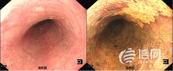 城陽區人民醫院開展內鏡下食管粘膜碘染色 讓早癌無處躲