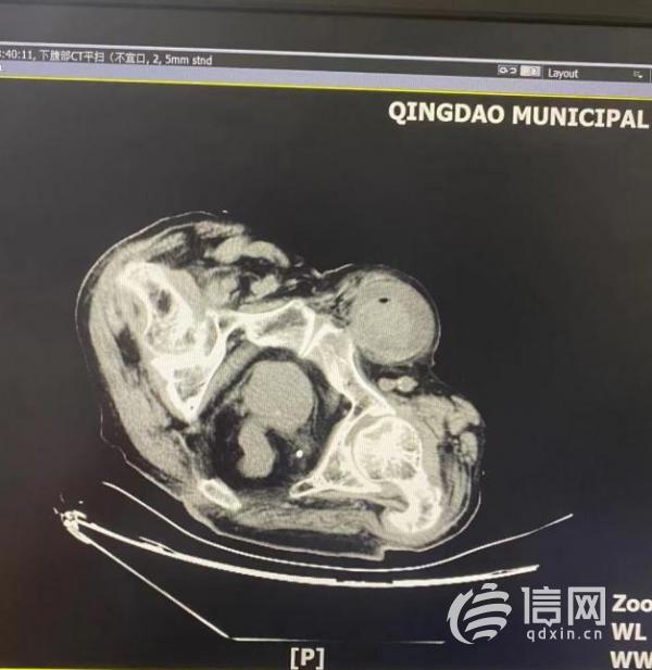 百岁老人腹部突现拳头市立医院多学科联手转危为安