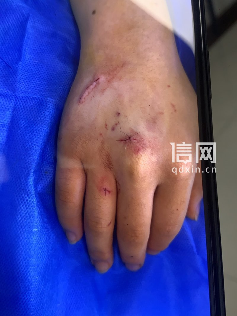 小李手部受伤情况（来源：受访者）