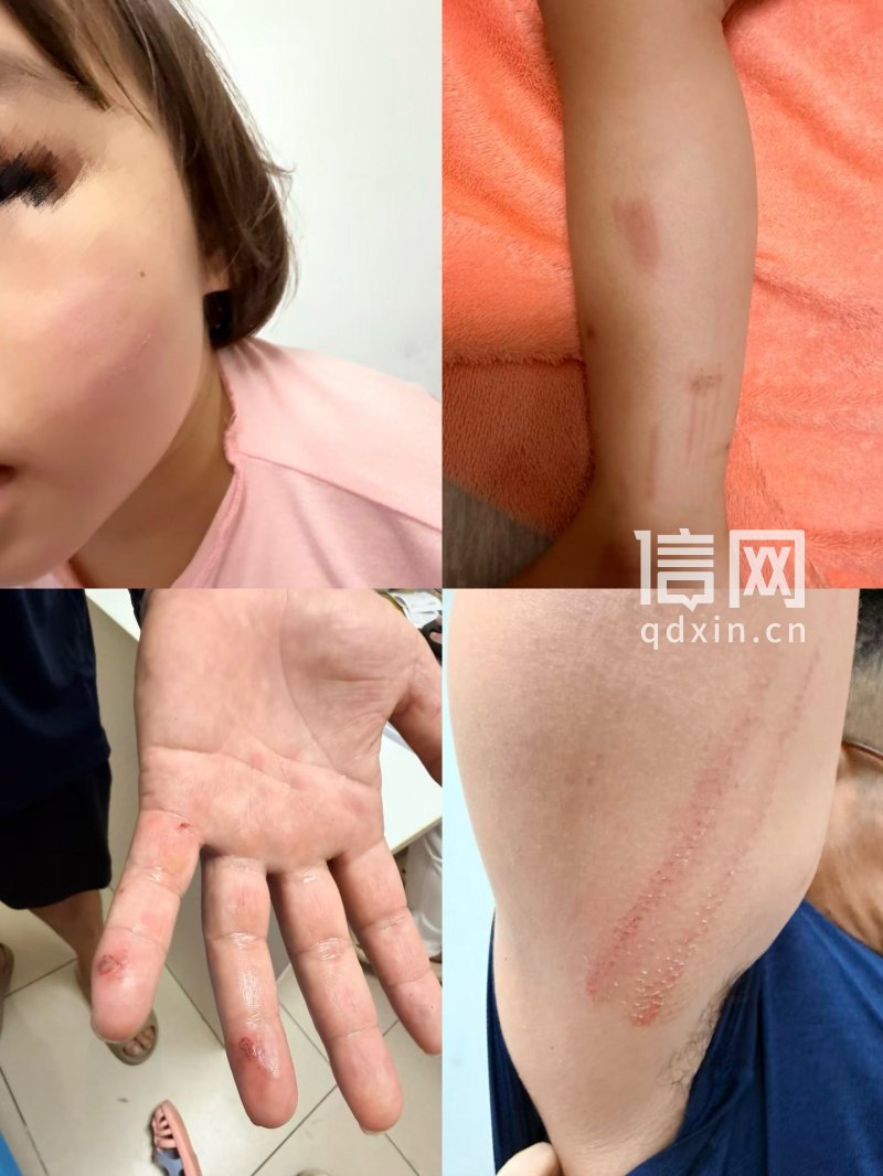 女童与孩子父亲身上均有不同程度的擦伤。（来源：受访者）