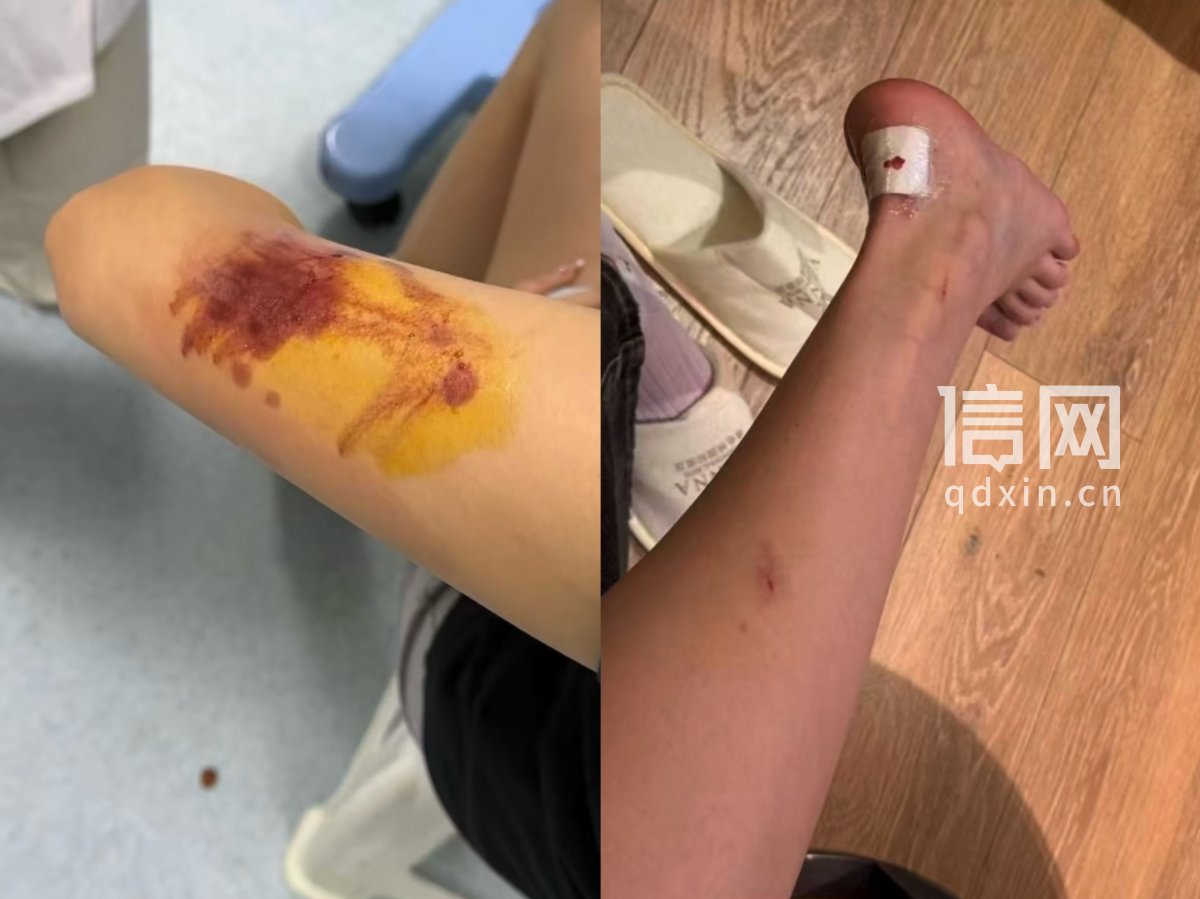 李女士身上多处被玻璃划伤。（来源：受访者）