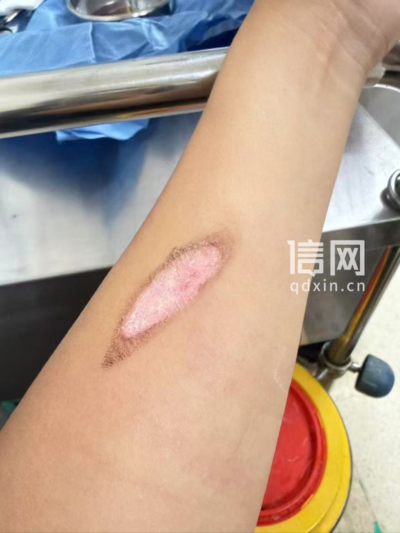 烫伤一周，清创治疗中（来源：受访者）
