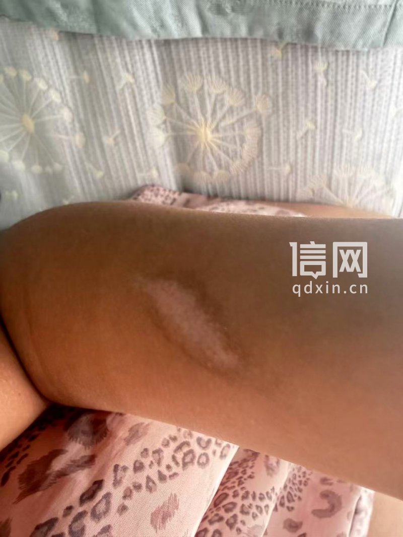 治疗一个月，色脱疤痕难以消退（来源：受访者）